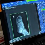 A close-up of a computer monitor displaying an X-ray of a foot with medical interface tools and patient data fields.