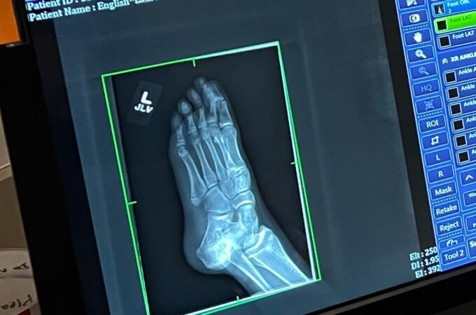 A close-up of a computer monitor displaying an X-ray of a foot with medical interface tools and patient data fields.