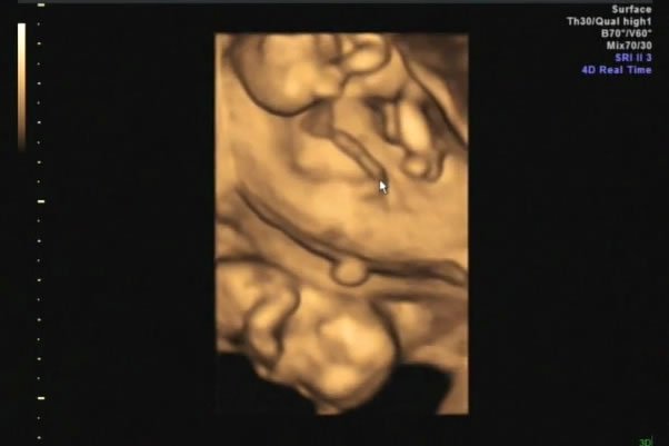 A detailed 3D ultrasound image showing the profile of a fetus in the womb.