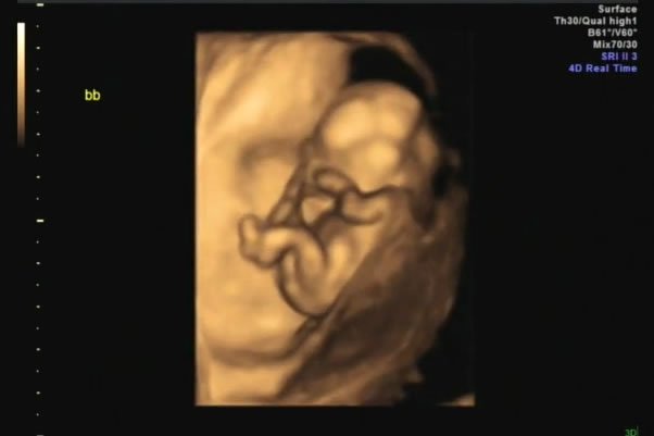 Close-up of Baby C's ear in an ultrasound image.