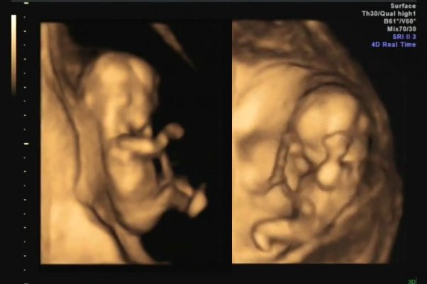 A collection of golden-tinted 4D ultrasound images showing a baby's face and profile. These pictures capture intimate moments of our growing family.