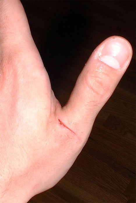 A hand showing two small cuts, one on the thumb and another near the base of the thumb, against a dark background.