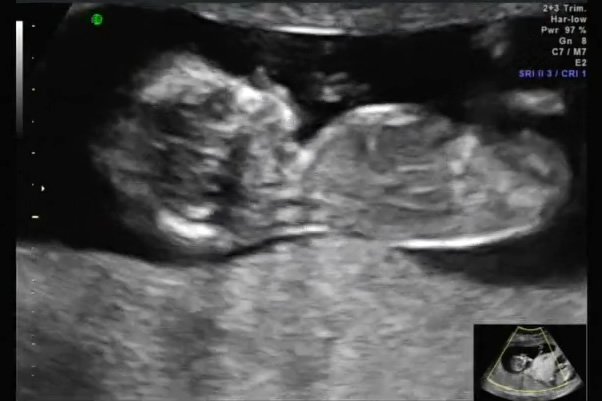 Black and white ultrasound scans showing a developing fetus. A small thumbnail image in the corner provides context.